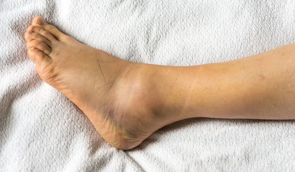Symptoms Of Midfoot Sprain Pain and Swelling