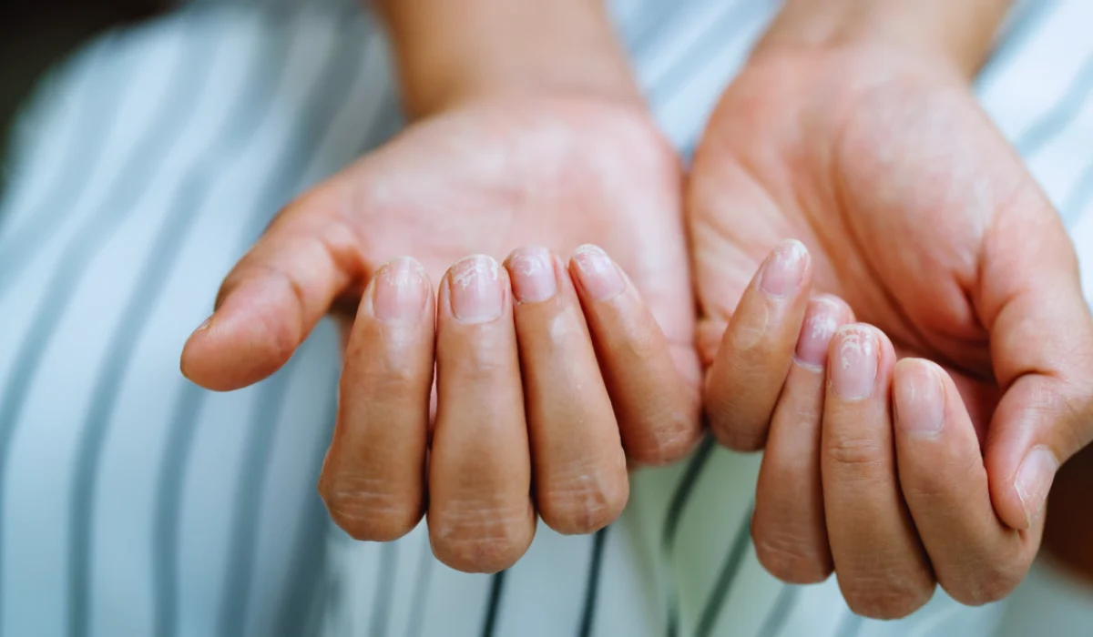 Fingernails After Menopause