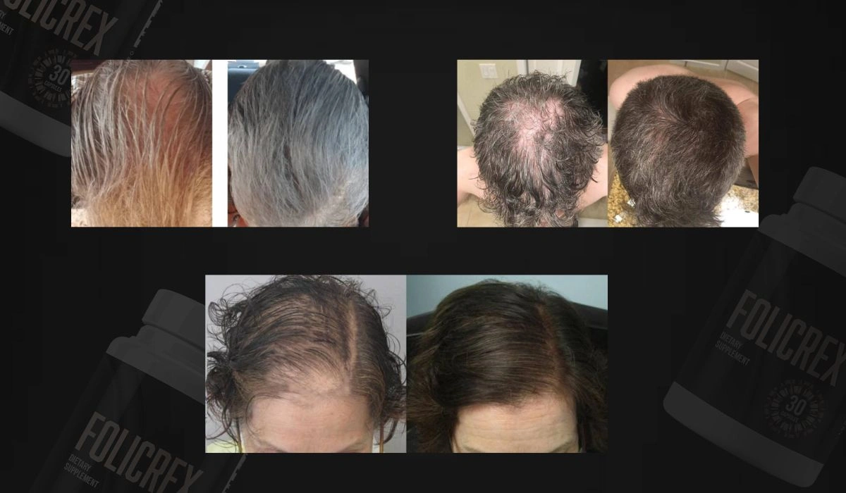 Folicrex Before And After
