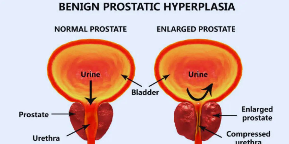 Prevent Benign Prostatic Hyperplasia