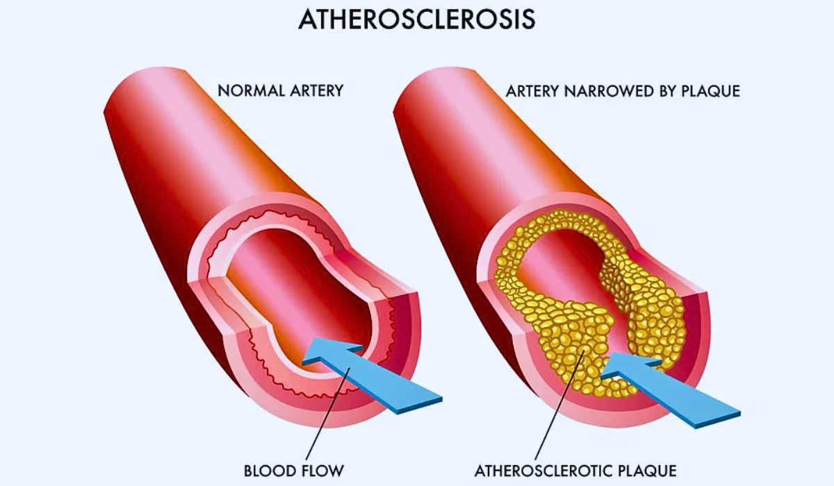 Atherosclerosis Types