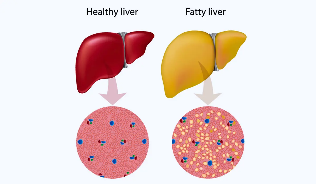 Best Practices To Remove Fat From The Liver