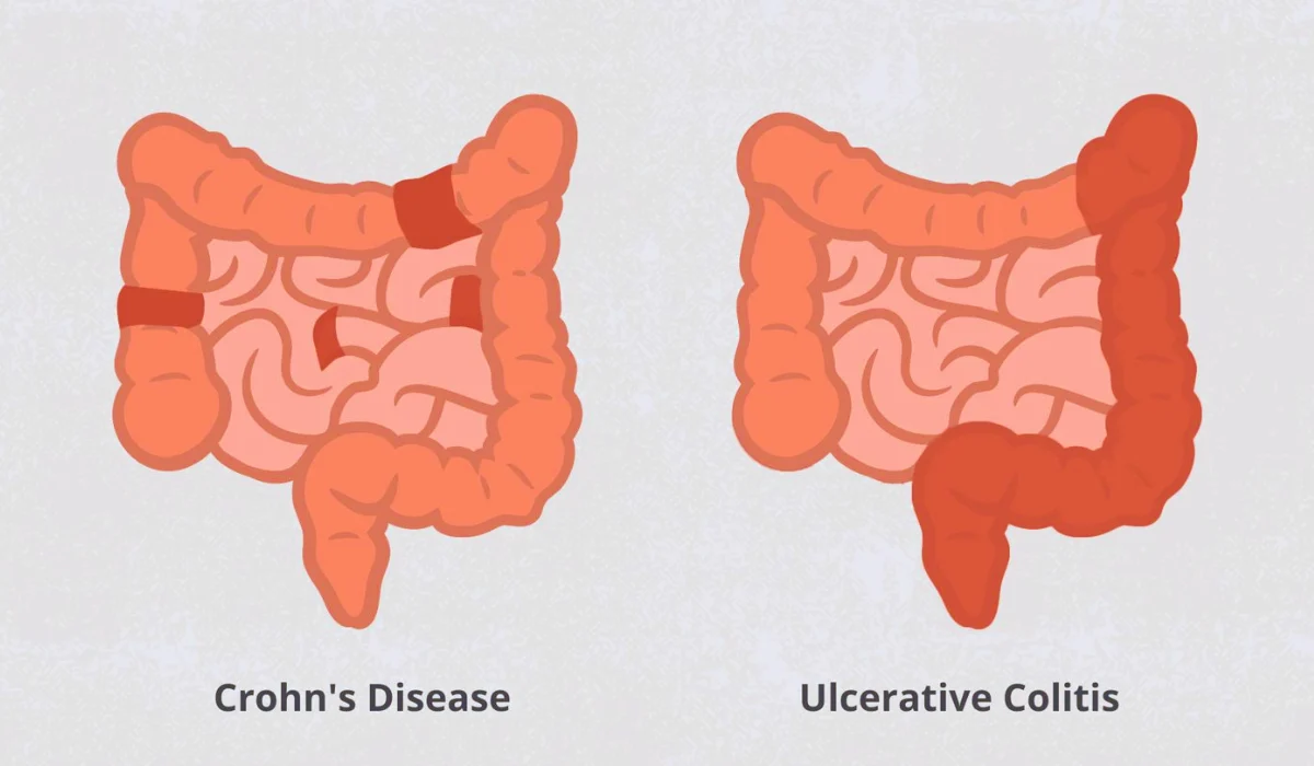 Causes For Crohn’s Disease