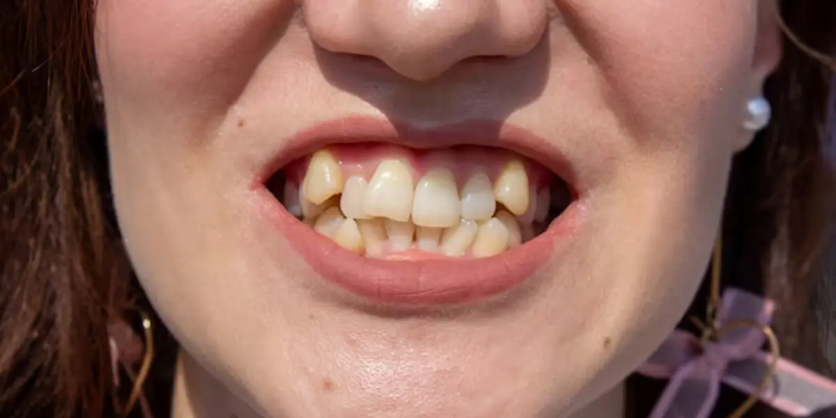 Causes Of Crooked Teeth 