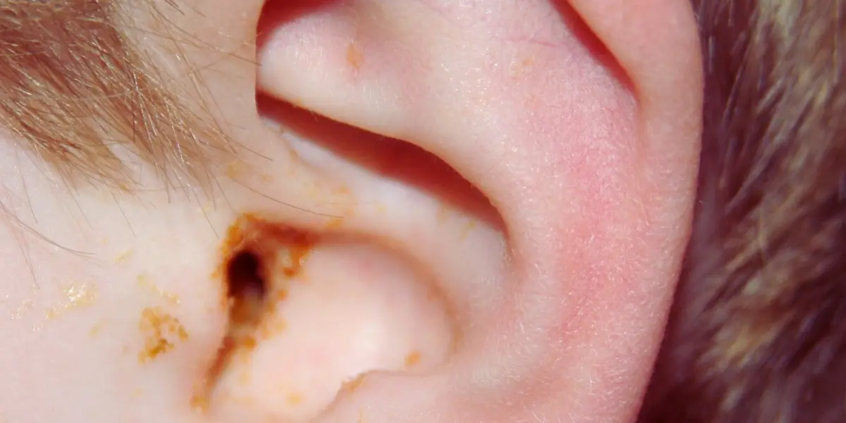 Causes Of Ear Infections