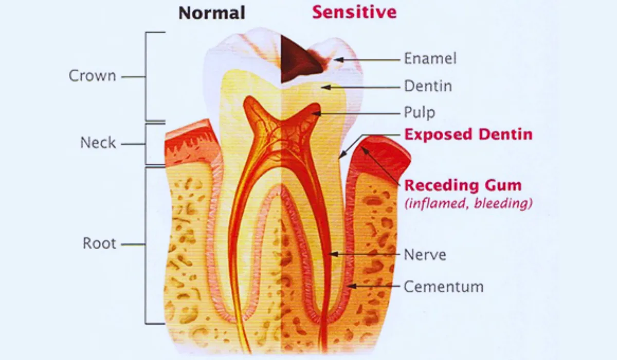 Causes behind sensitive teeth
