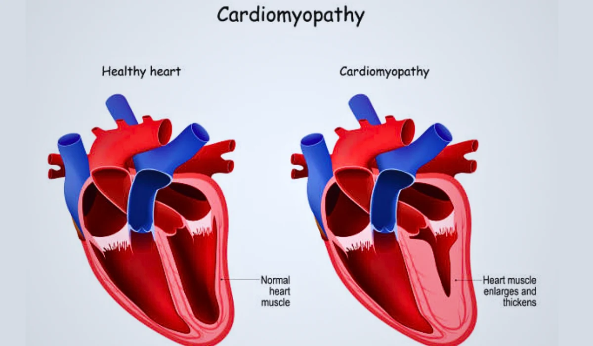 Causes of Cardiomyopathy