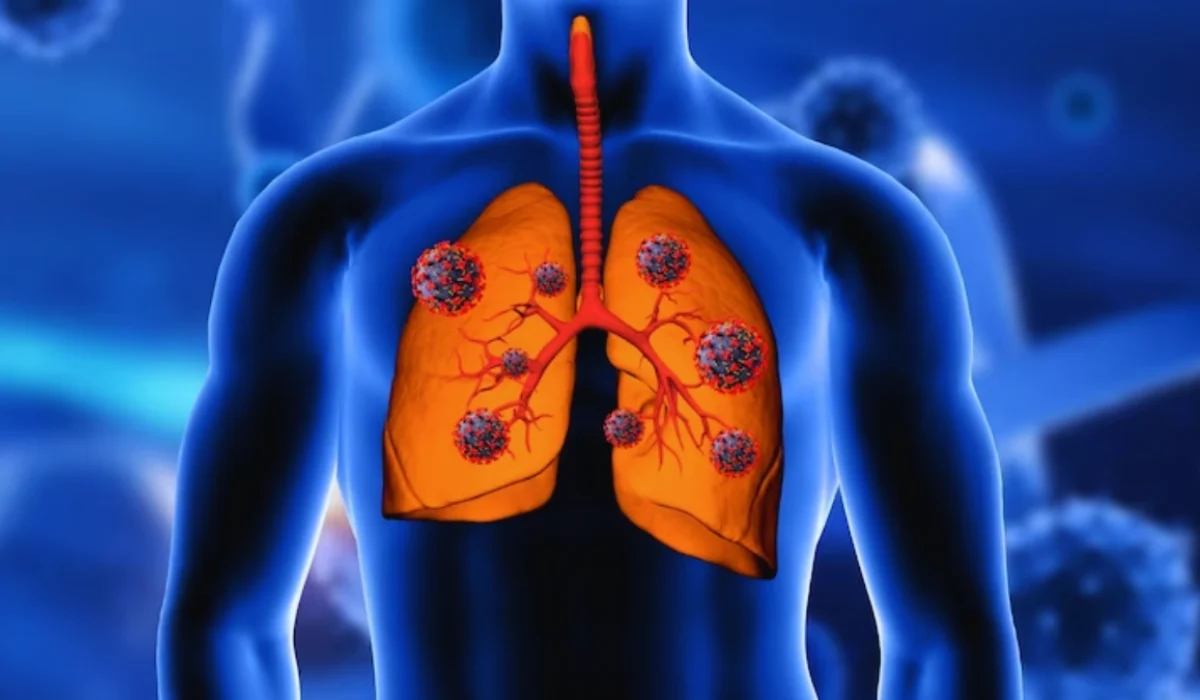 Causes of Lung cancer