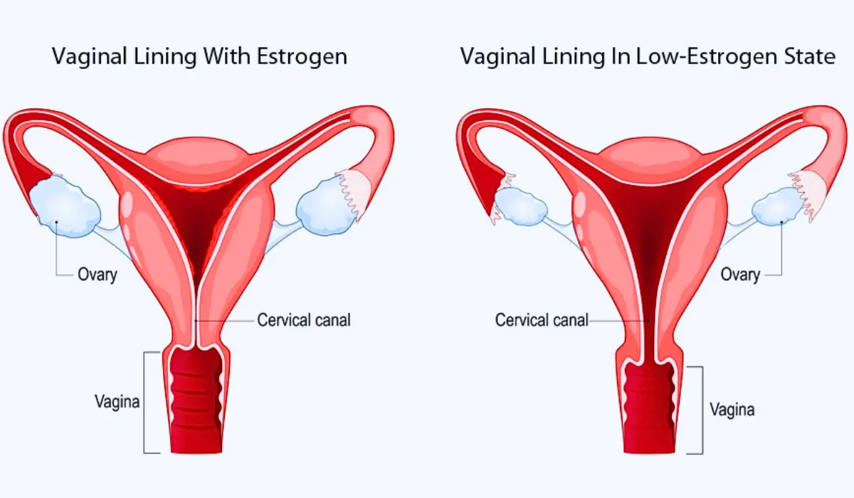 Causes of Vaginal Dryness After Menopause