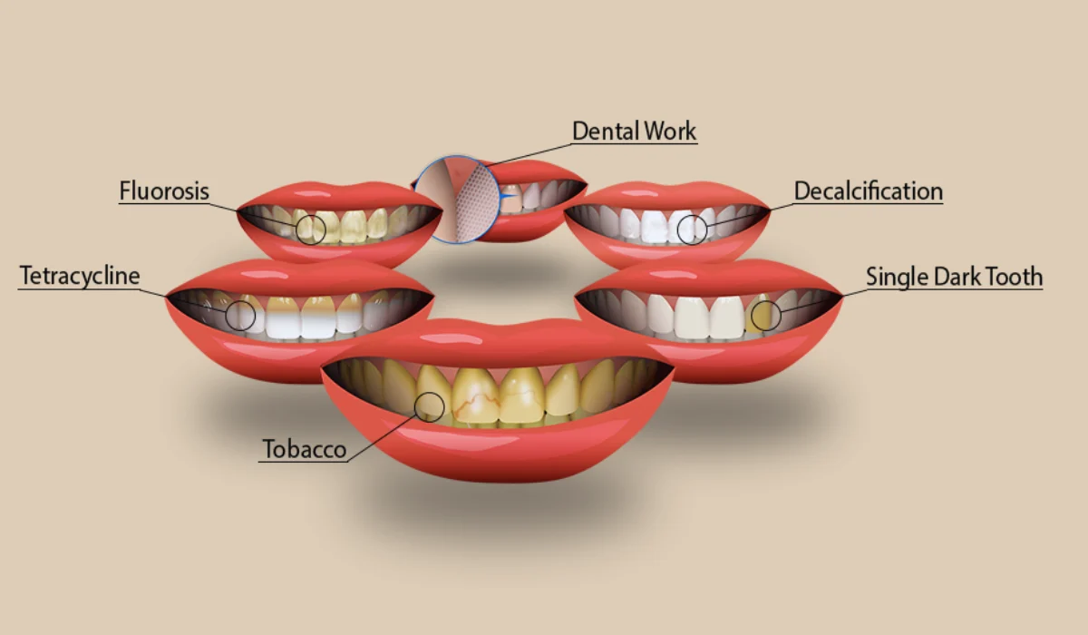 Causes of stained teeth