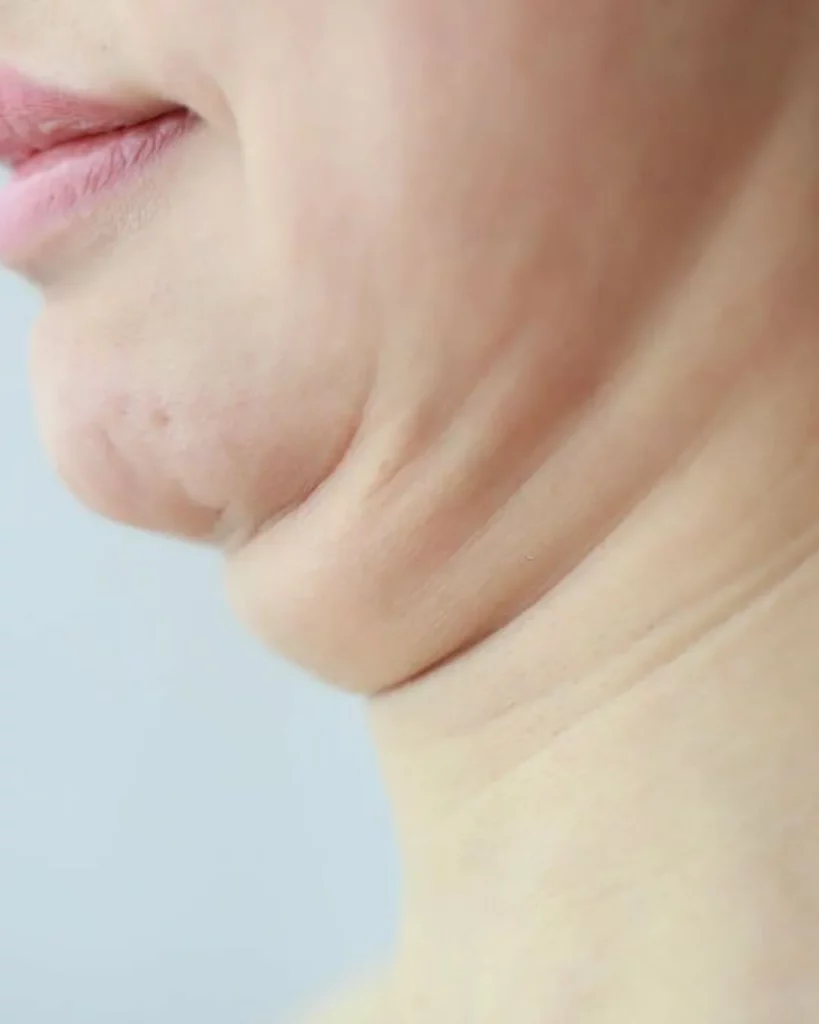How To Get Rid Of Neck Fat