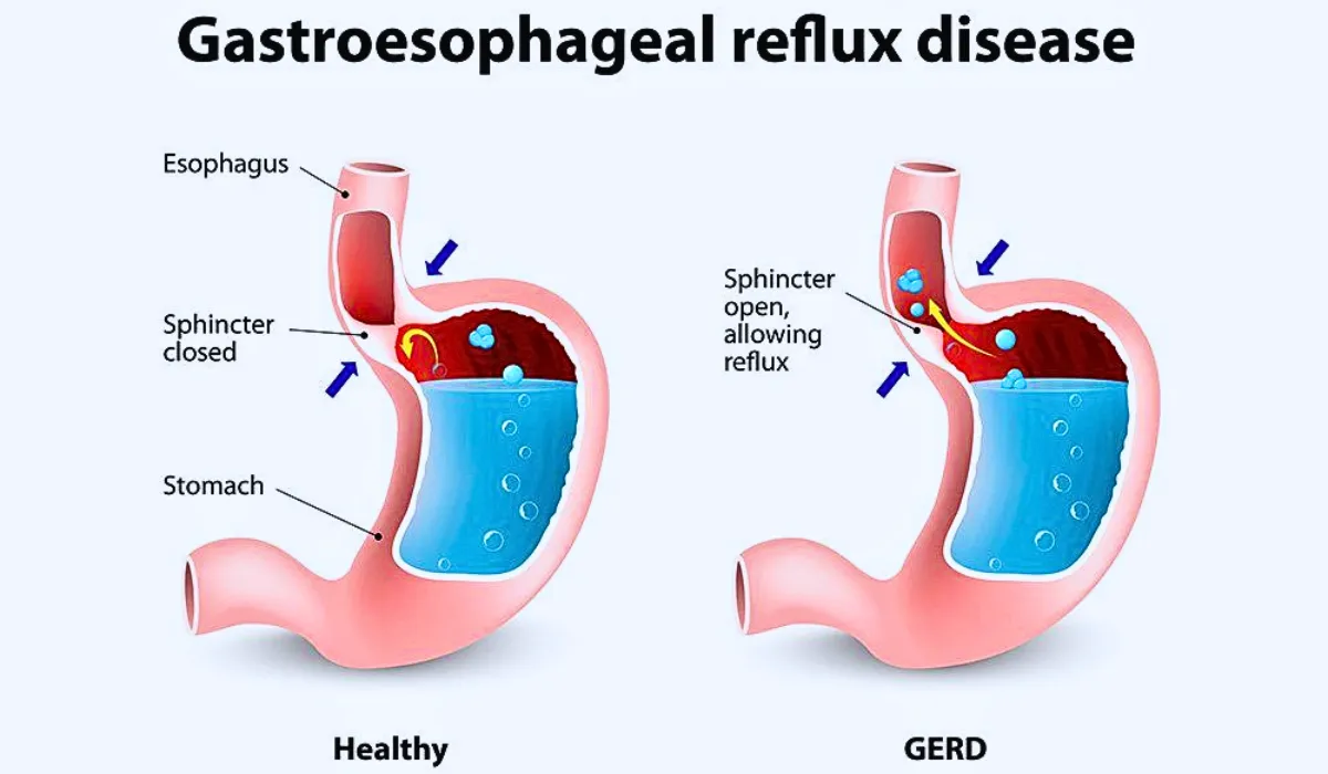 Gastroesophageal reflux