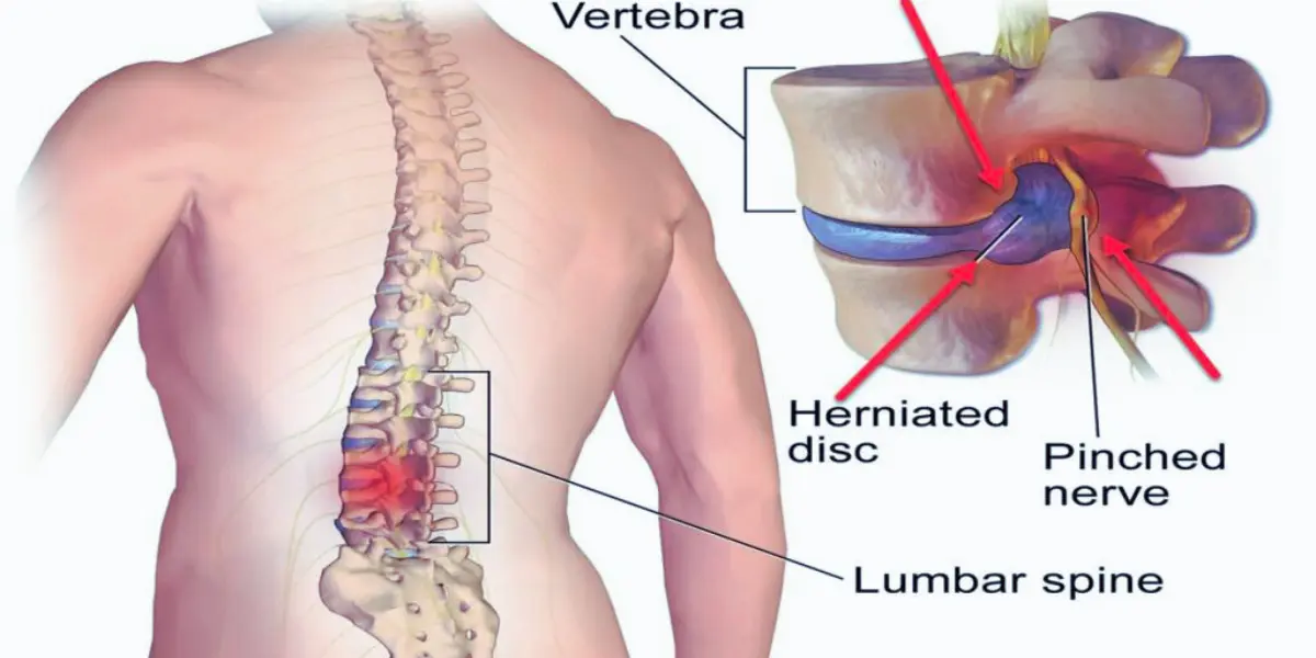 Herniated Disc Pain Areas