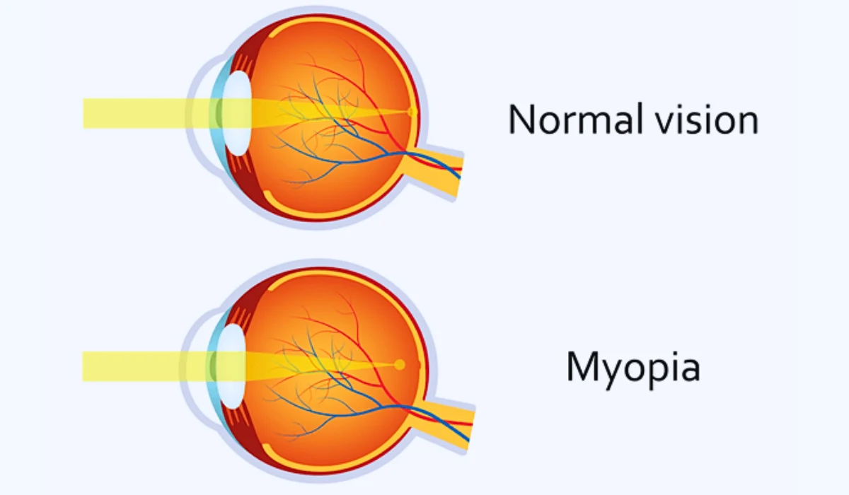 Myopia Causes 