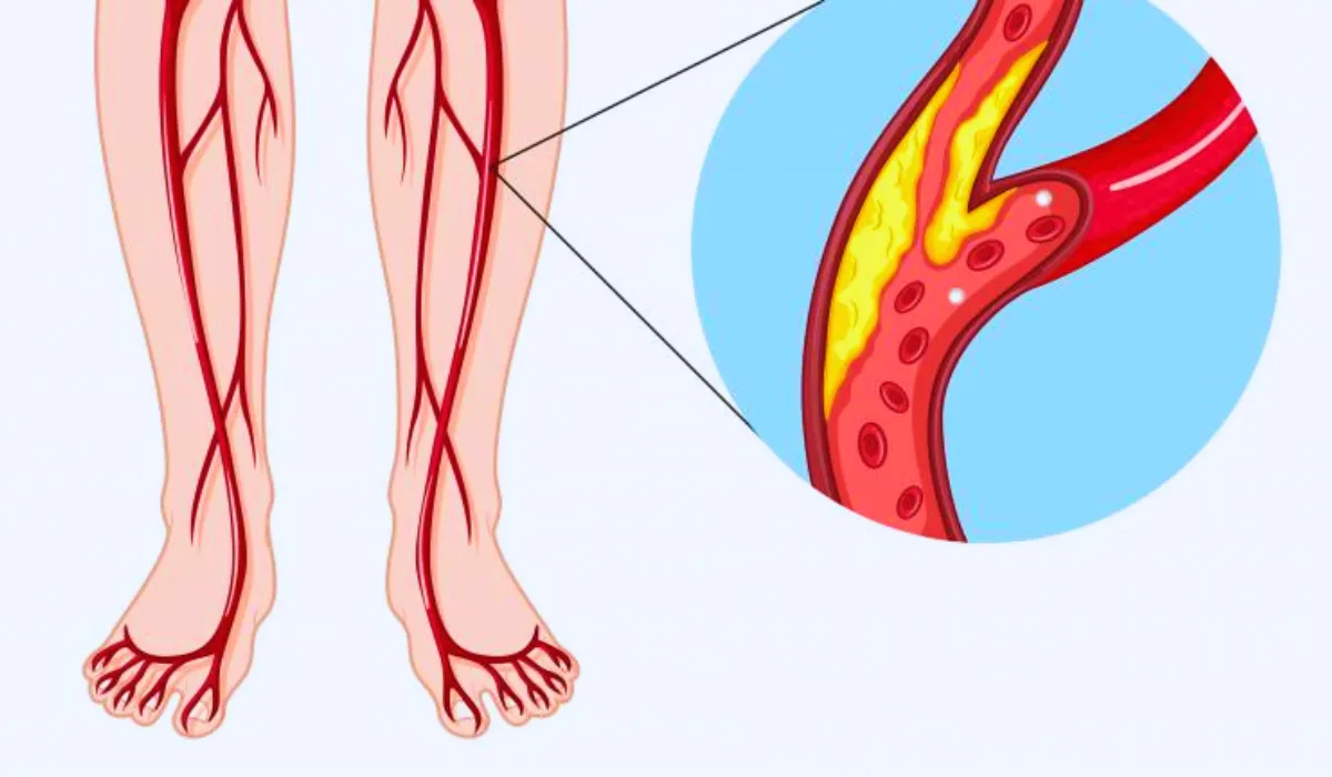 Peripheral Artery Disease Symptoms and Causes