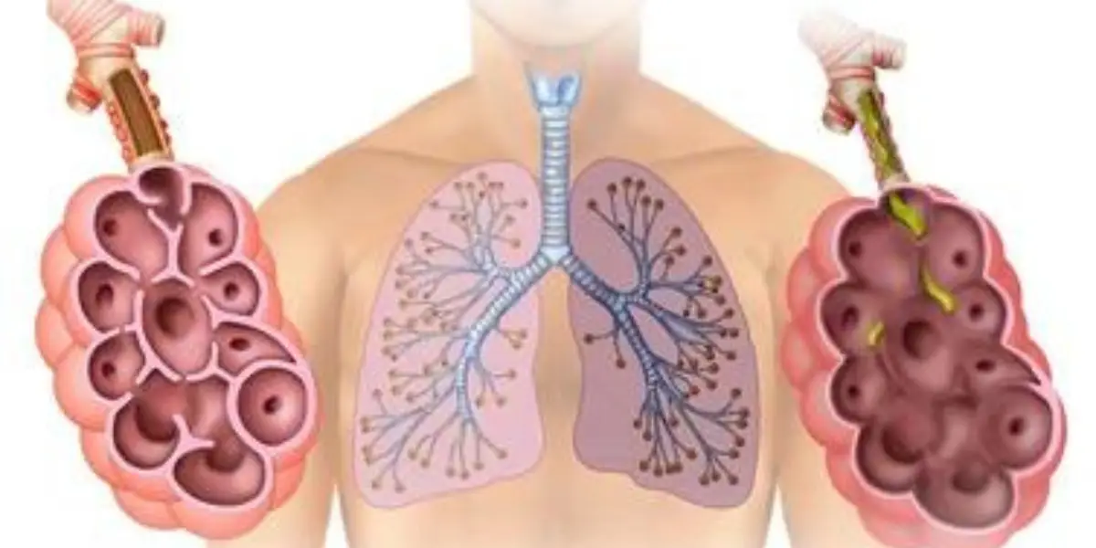 Symptoms Of Emphysema