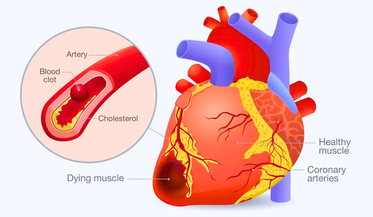 Top Cardiovascular Diseases