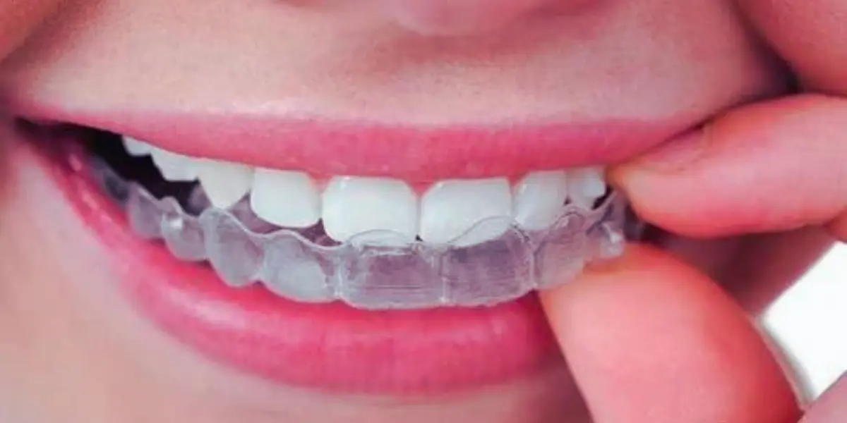 Treatment Options For Teeth Misalignment