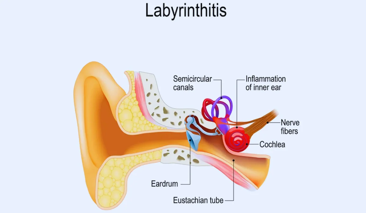 Treatments For Labyrinthitis