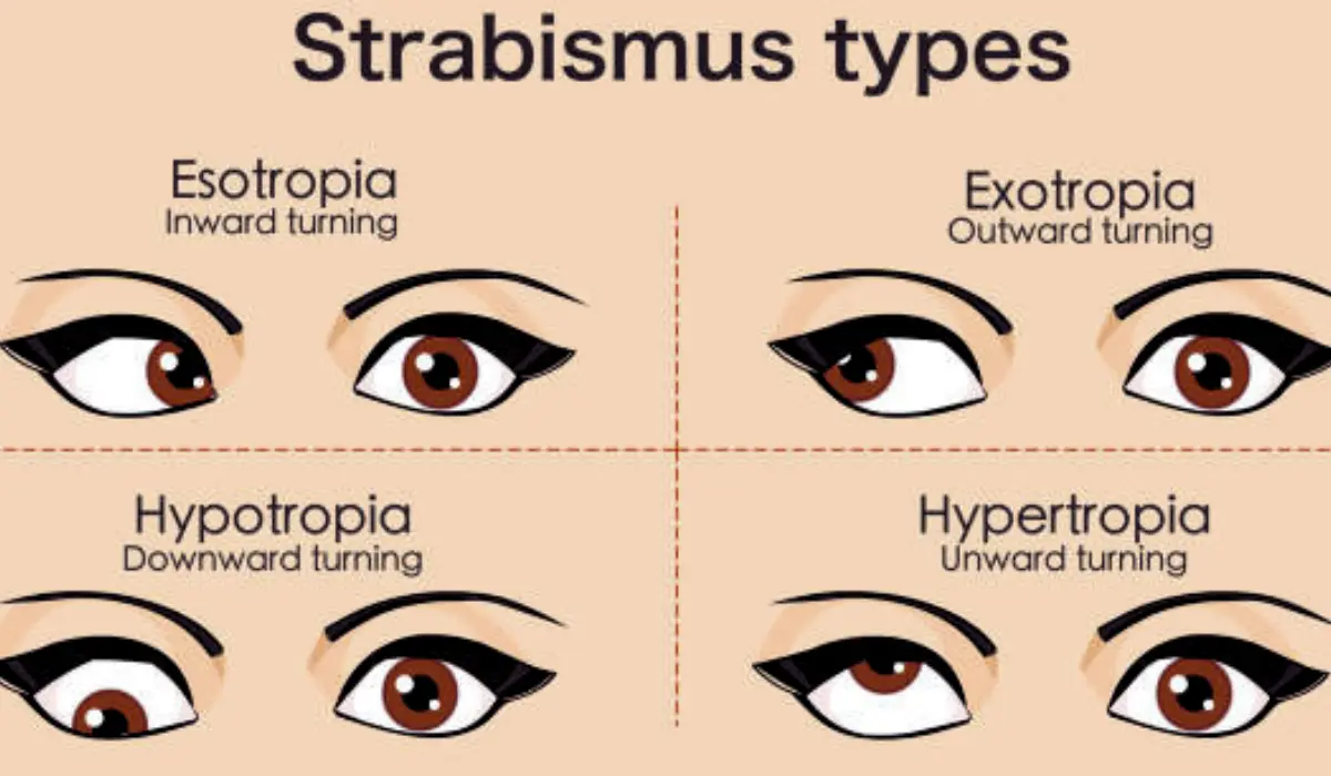 symptoms of strabismus