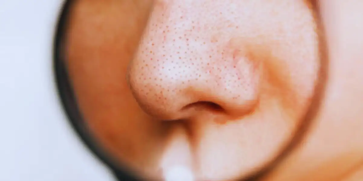 Blackheads And Causes