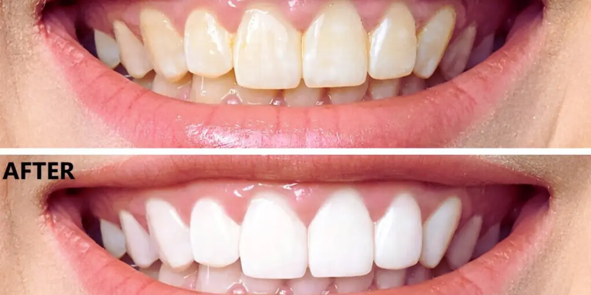 Considerations For Laser Teeth Whitening