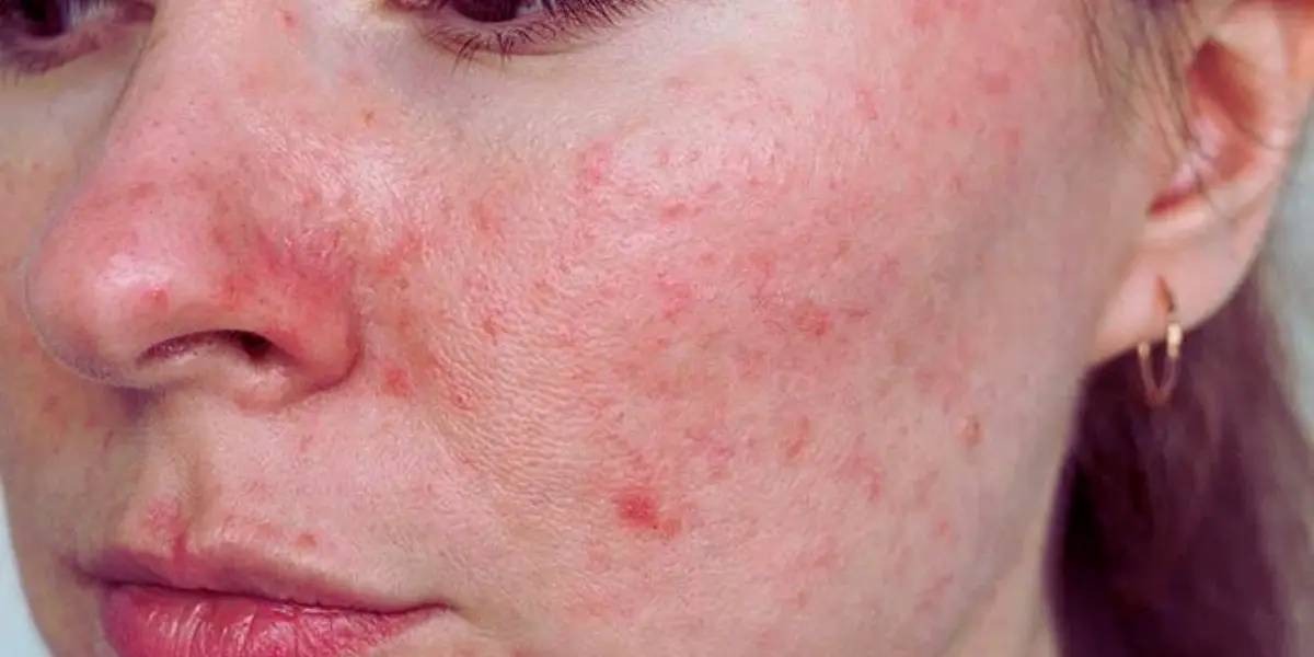Control Rosacea Effectively