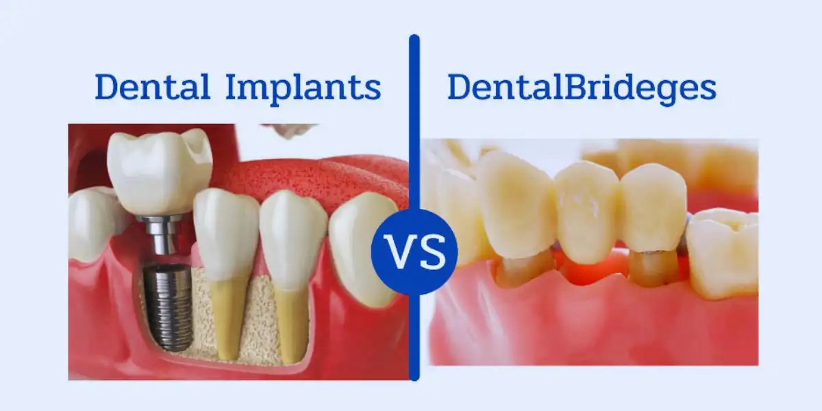 Differences Between A Dental Implant Or A Dental Bridge
