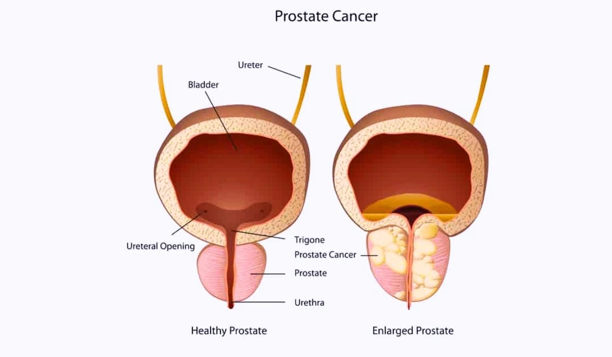 Symptoms Of Prostate Cancer 