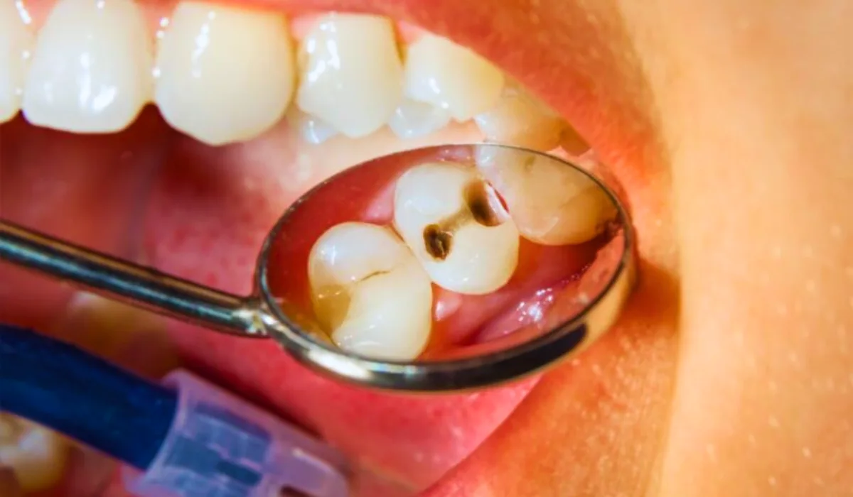 Remedies For Cavities Between Teeth