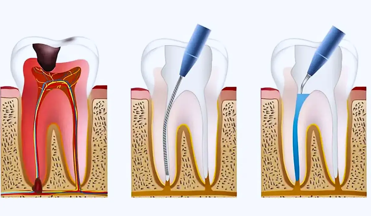 Root Canal Procedure for Front Teeth