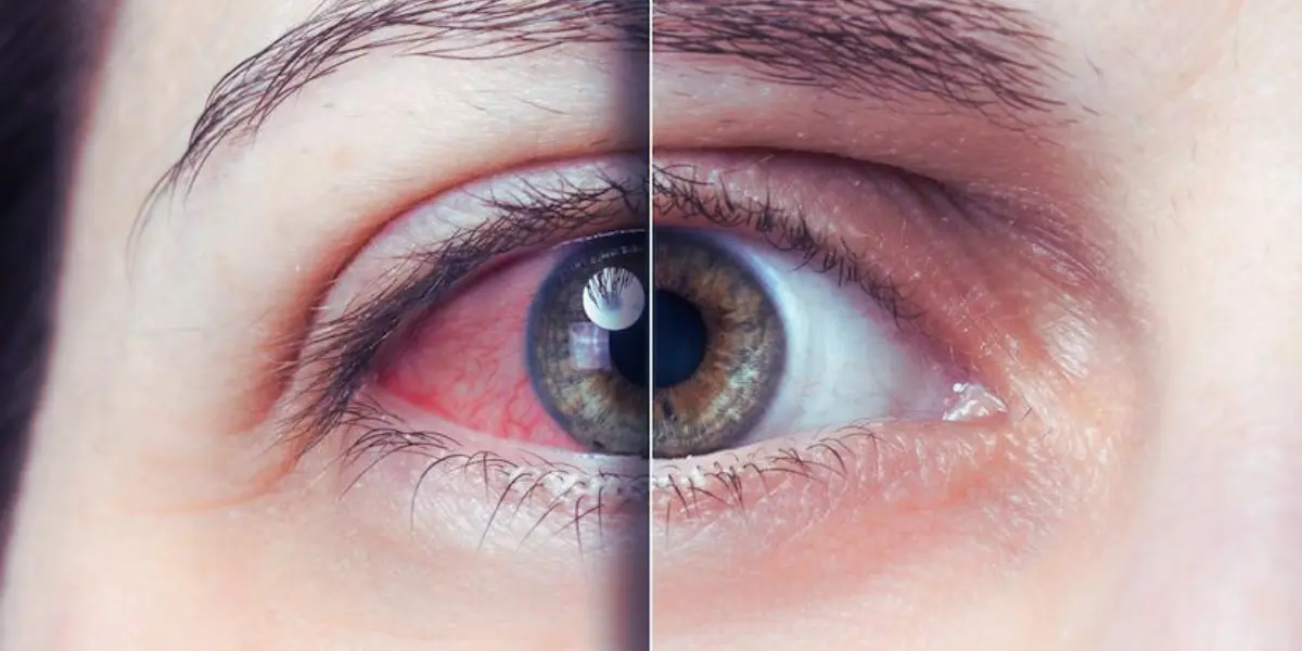 Taurine Deficiency And Eye