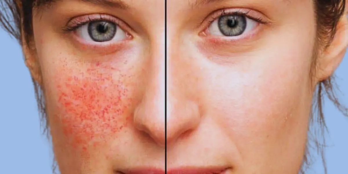 Treat And Control Rosacea Effectively