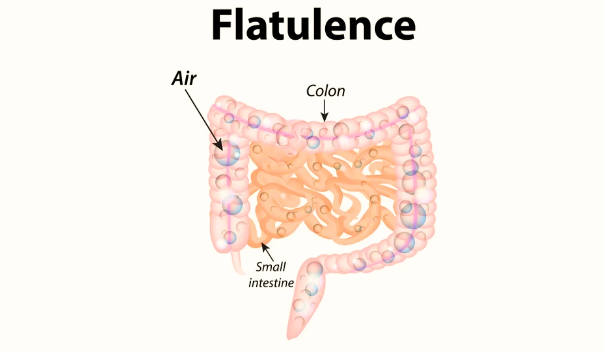 What causes flatulence