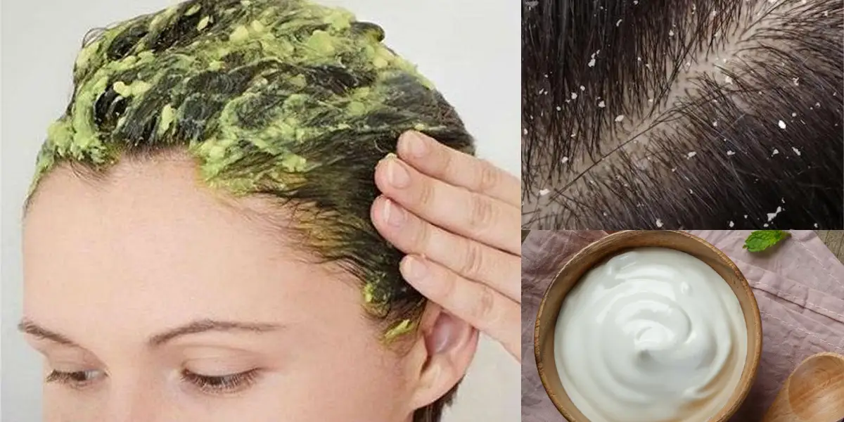 hair mask to use for dandruff
