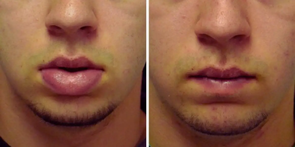lip reduction surgery cost