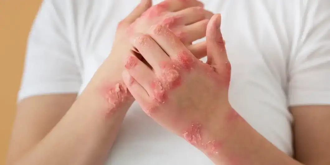 spongiotic dermatitis causes