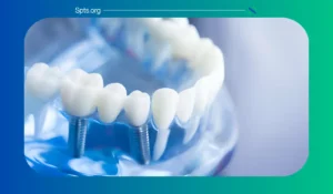 Main Reasons Not To Get Dental Implants