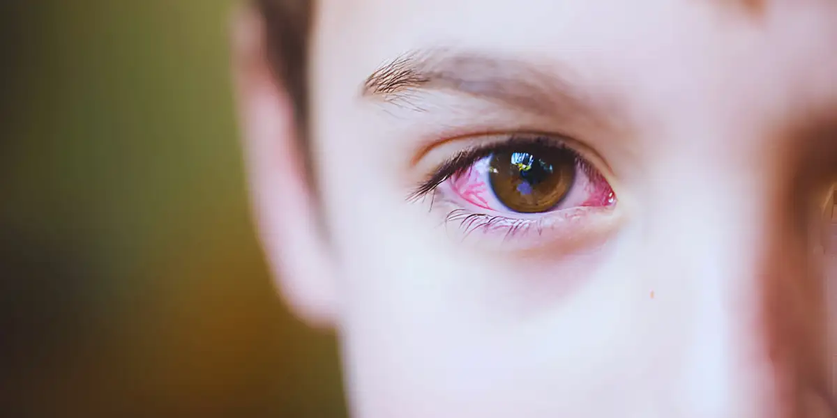 Pink Eye Disease
